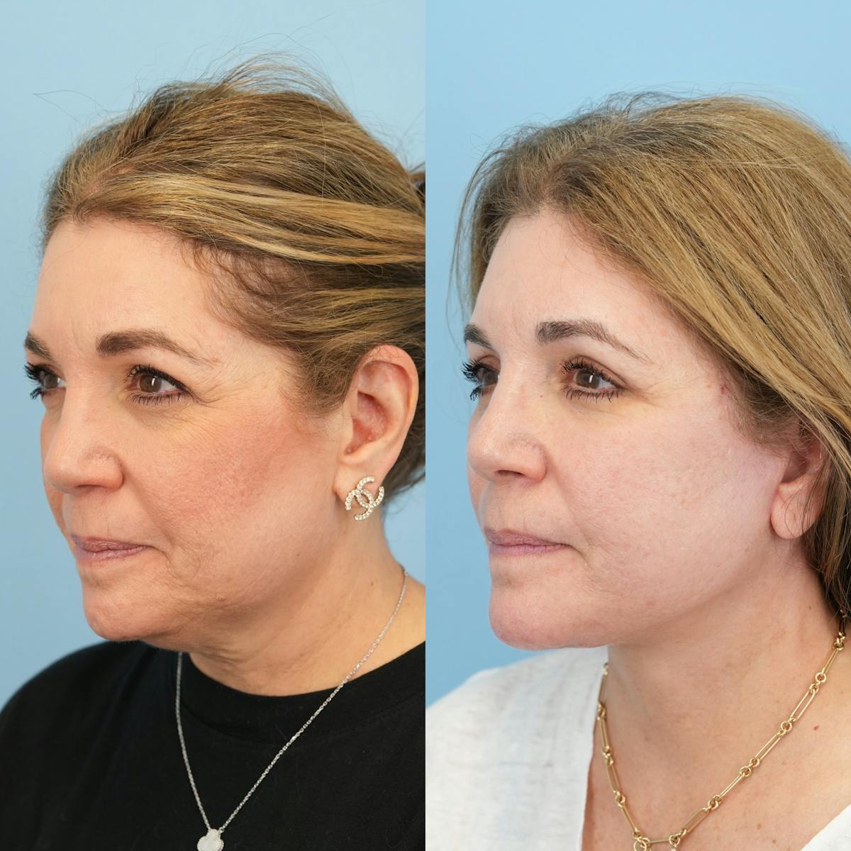 Facelift Before & After Gallery - Patient 422478 - Image 8