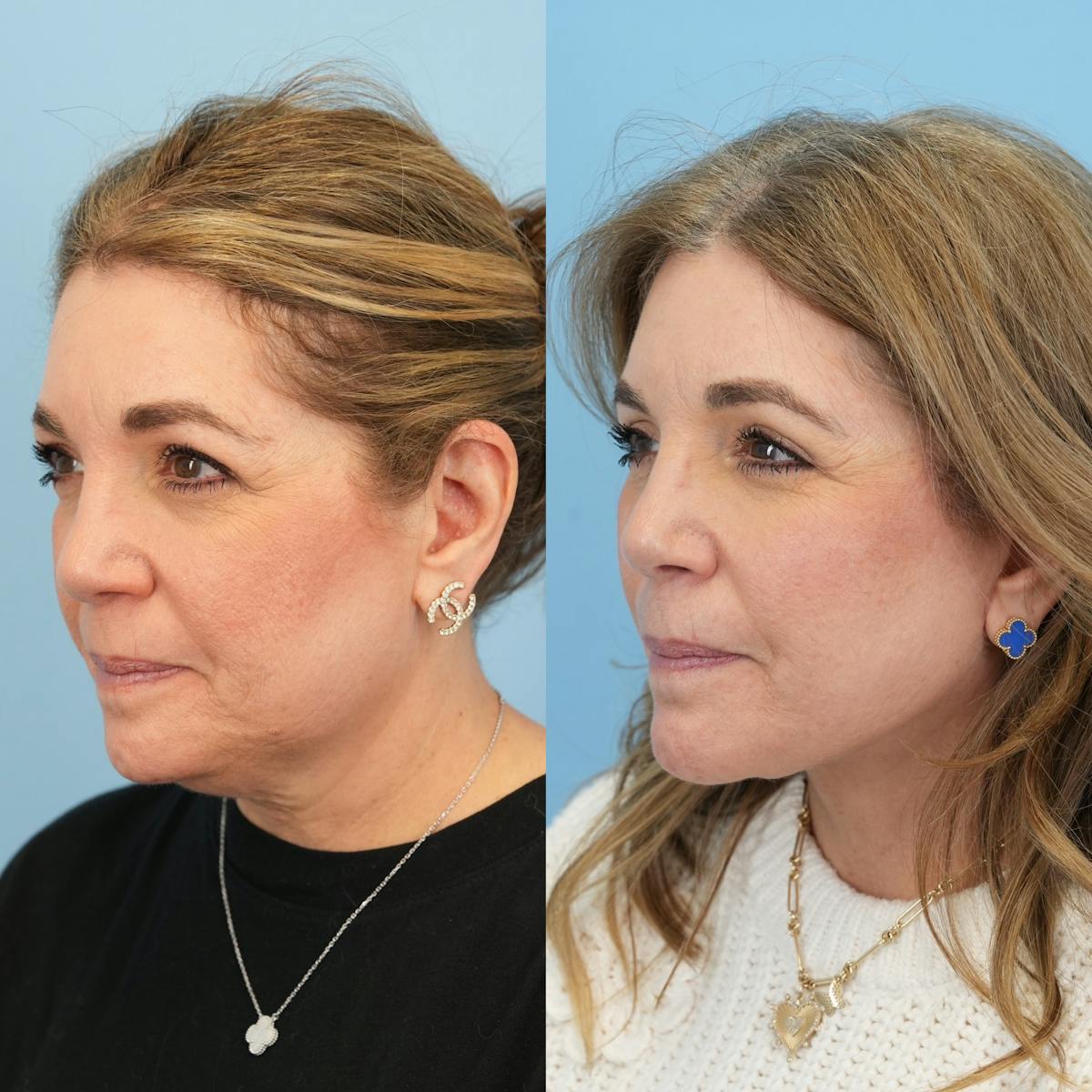 Facelift Before & After Gallery - Patient 422478 - Image 9