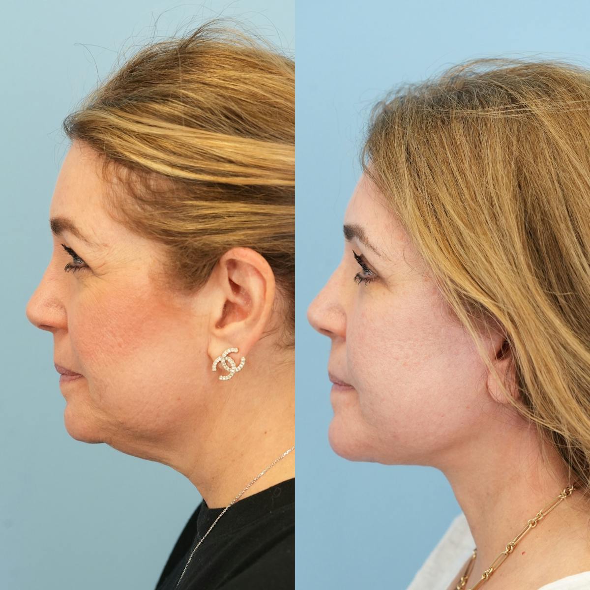 Facelift Before & After Gallery - Patient 422478 - Image 10