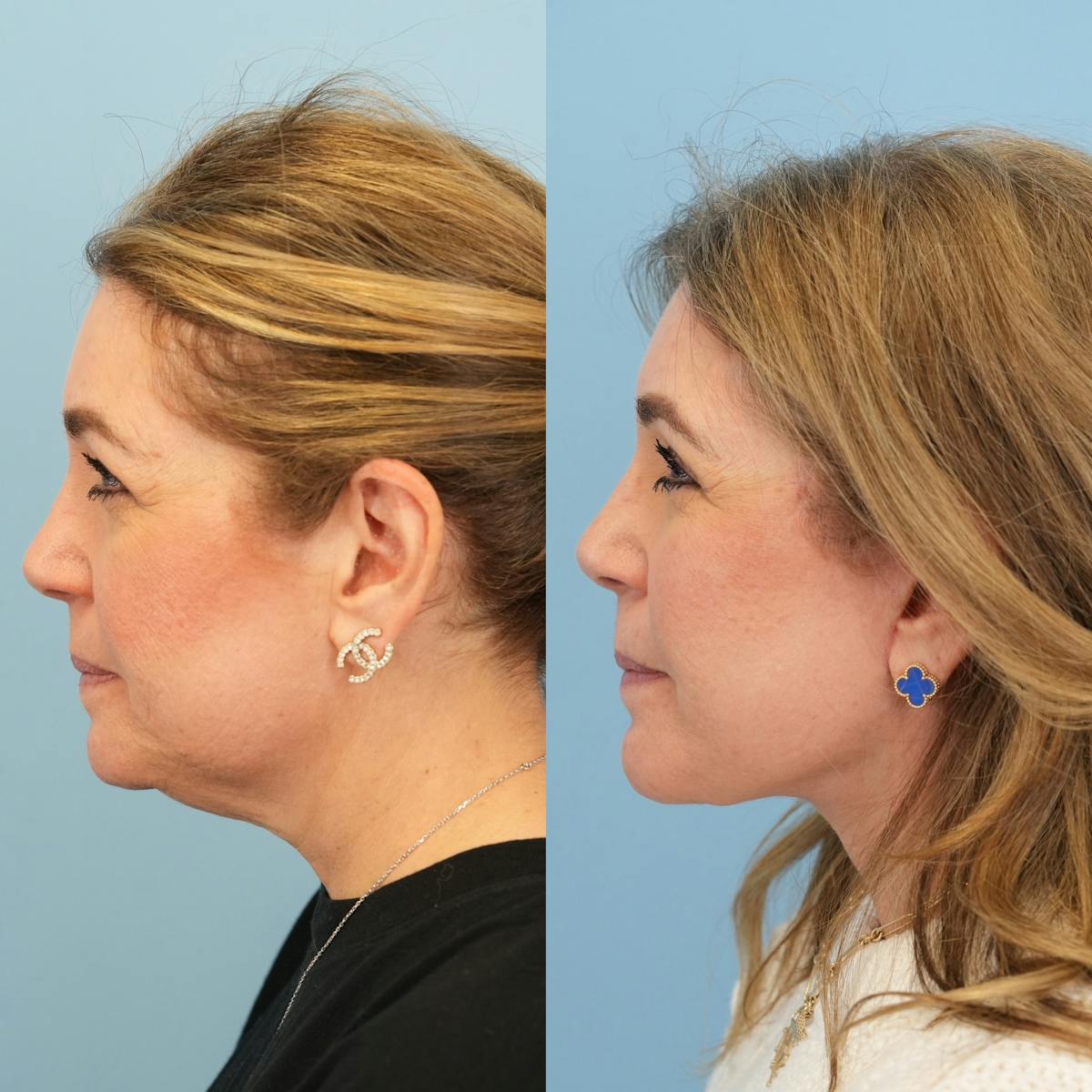 Facelift Before & After Gallery - Patient 422478 - Image 11