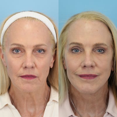 Facelift Before & After Gallery - Patient 392524 - Image 1