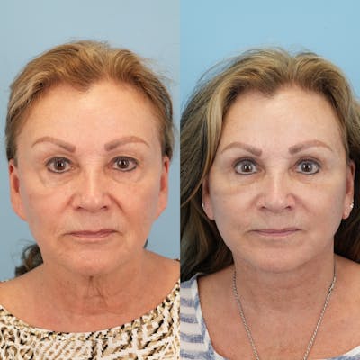 Lower Eyelids Before & After Gallery - Patient 342767 - Image 1