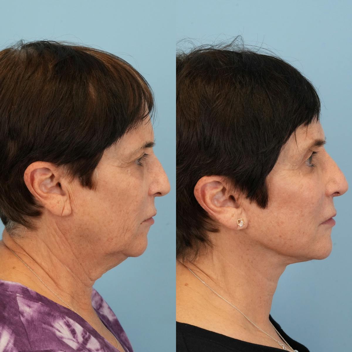 Facelift Before & After Gallery - Patient 131777 - Image 4