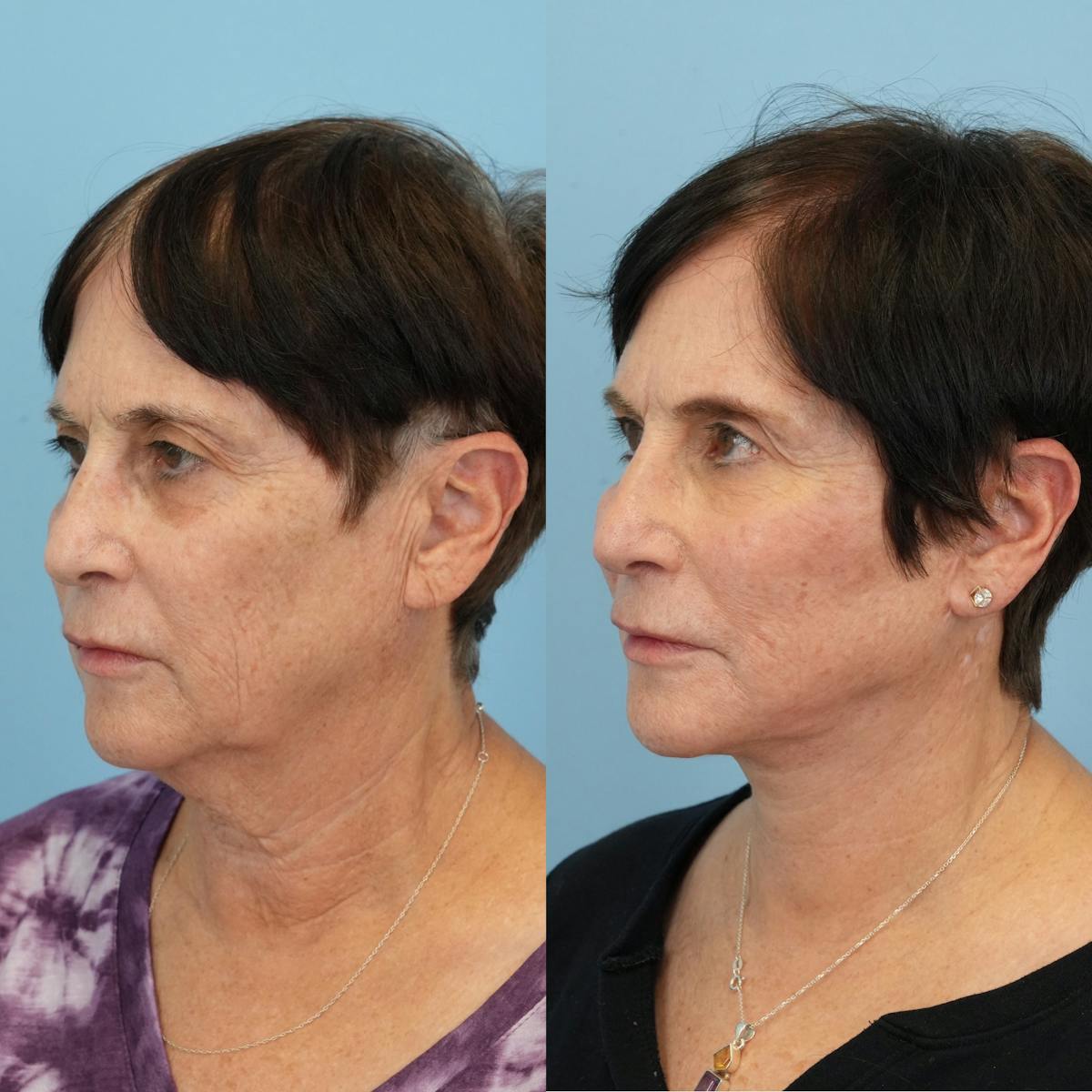 Facelift Before & After Gallery - Patient 131777 - Image 5