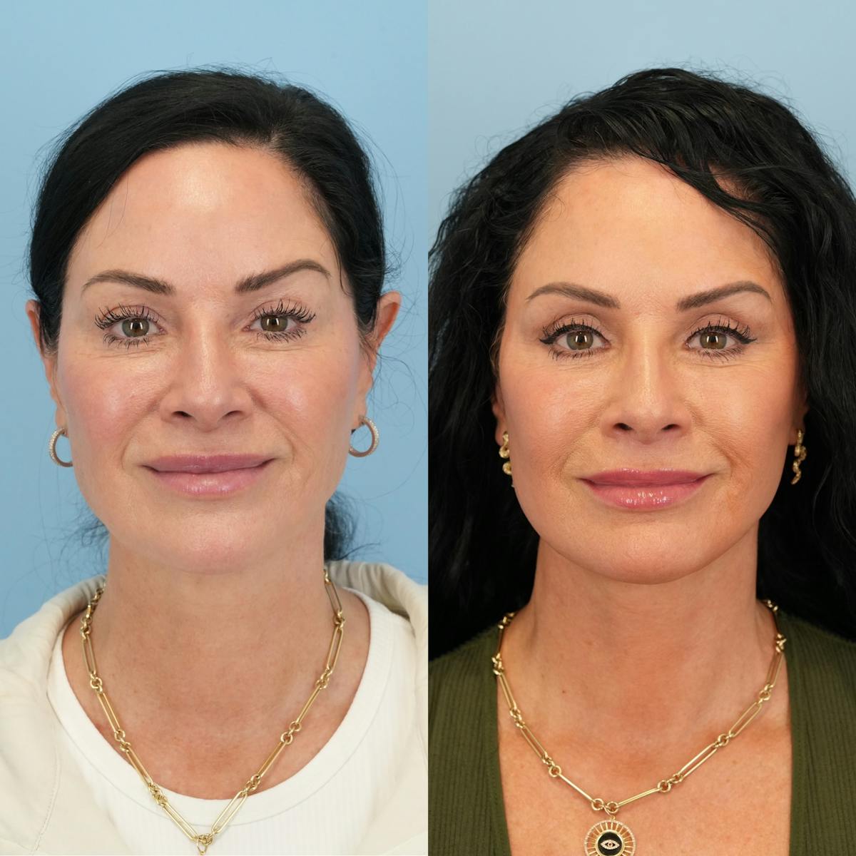 Facelift Before & After Gallery - Patient 941982 - Image 1