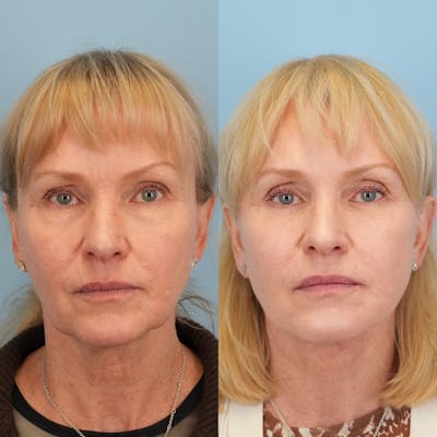 Facelift Before & After Gallery - Patient 130126 - Image 1
