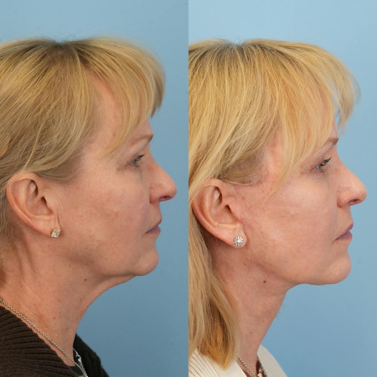 Facelift Before & After Gallery - Patient 130126 - Image 3