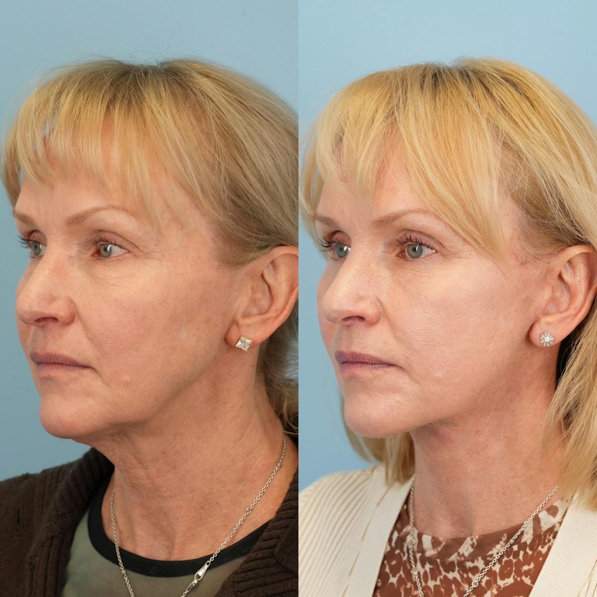 Facelift Before & After Gallery - Patient 130126 - Image 4
