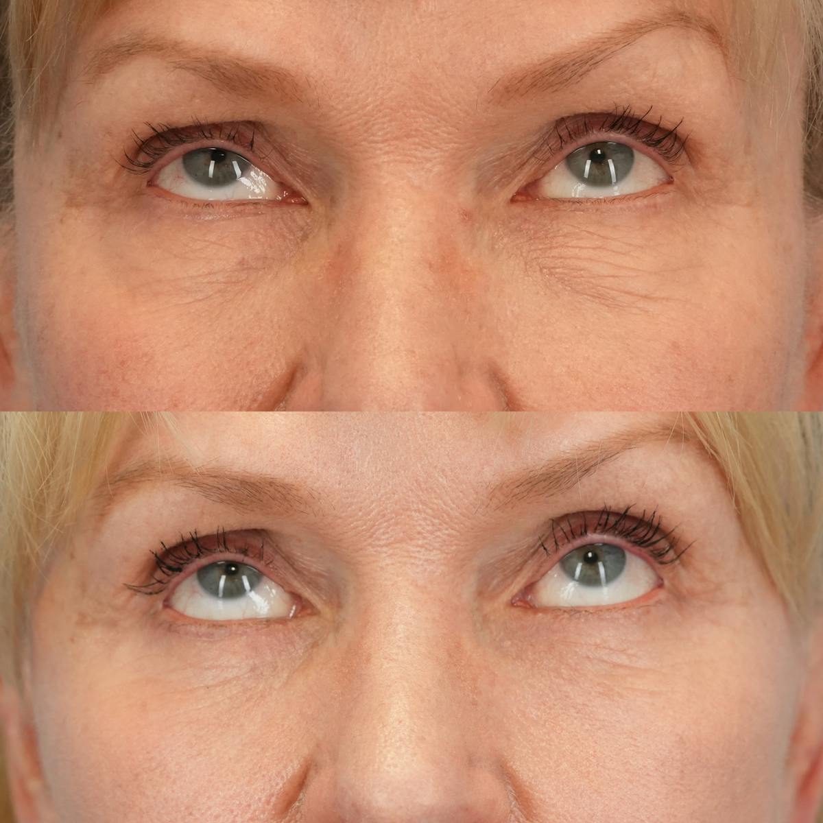Facelift Before & After Gallery - Patient 130126 - Image 6