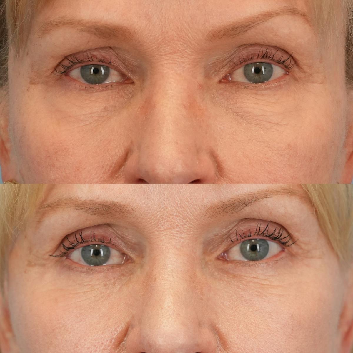 Facelift Before & After Gallery - Patient 130126 - Image 7