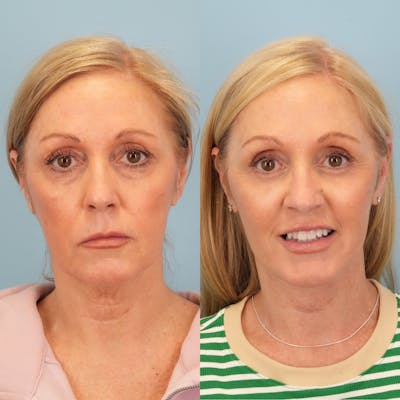 Lower Eyelids Before & After Gallery - Patient 398807 - Image 1