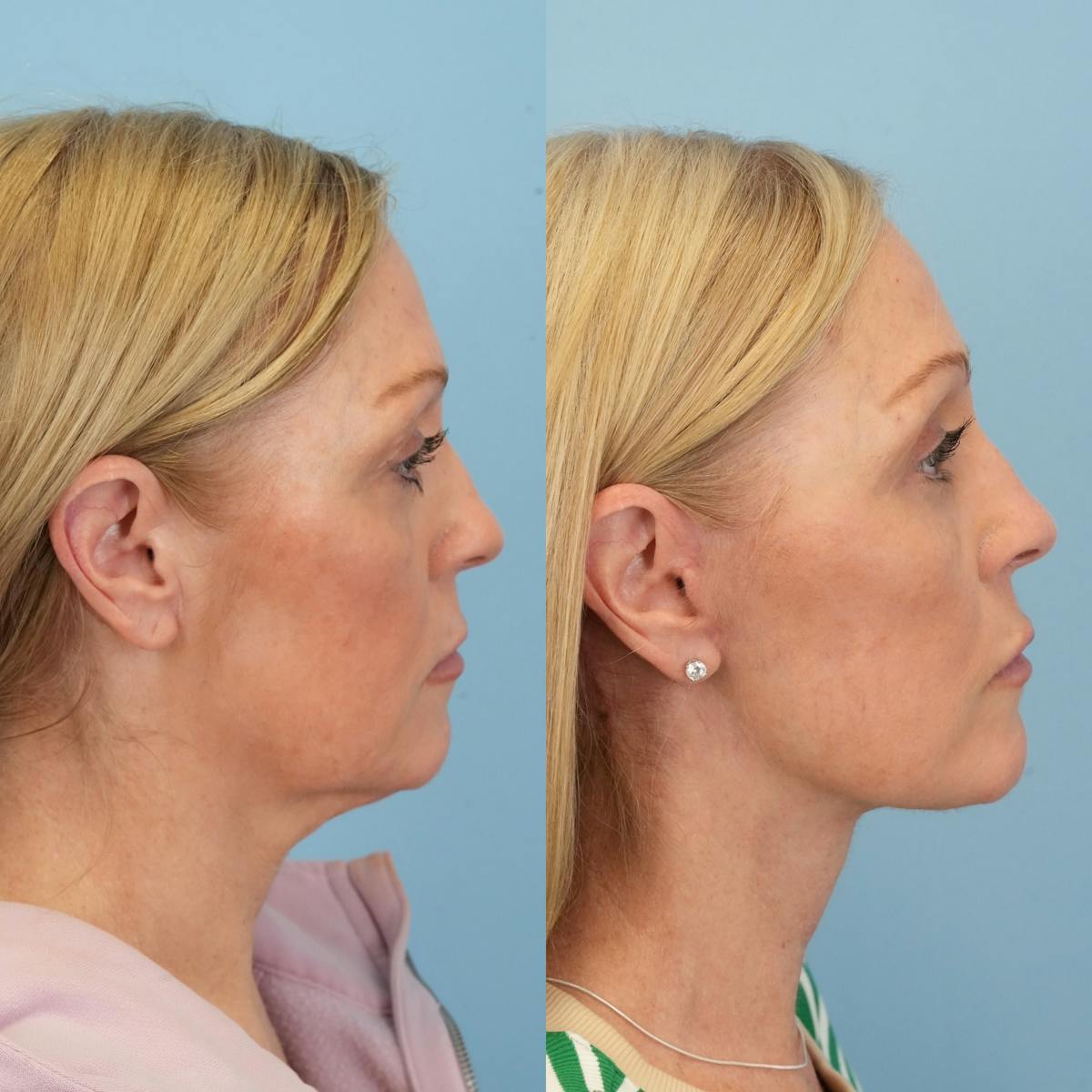 Facelift Before & After Gallery - Patient 179170 - Image 3