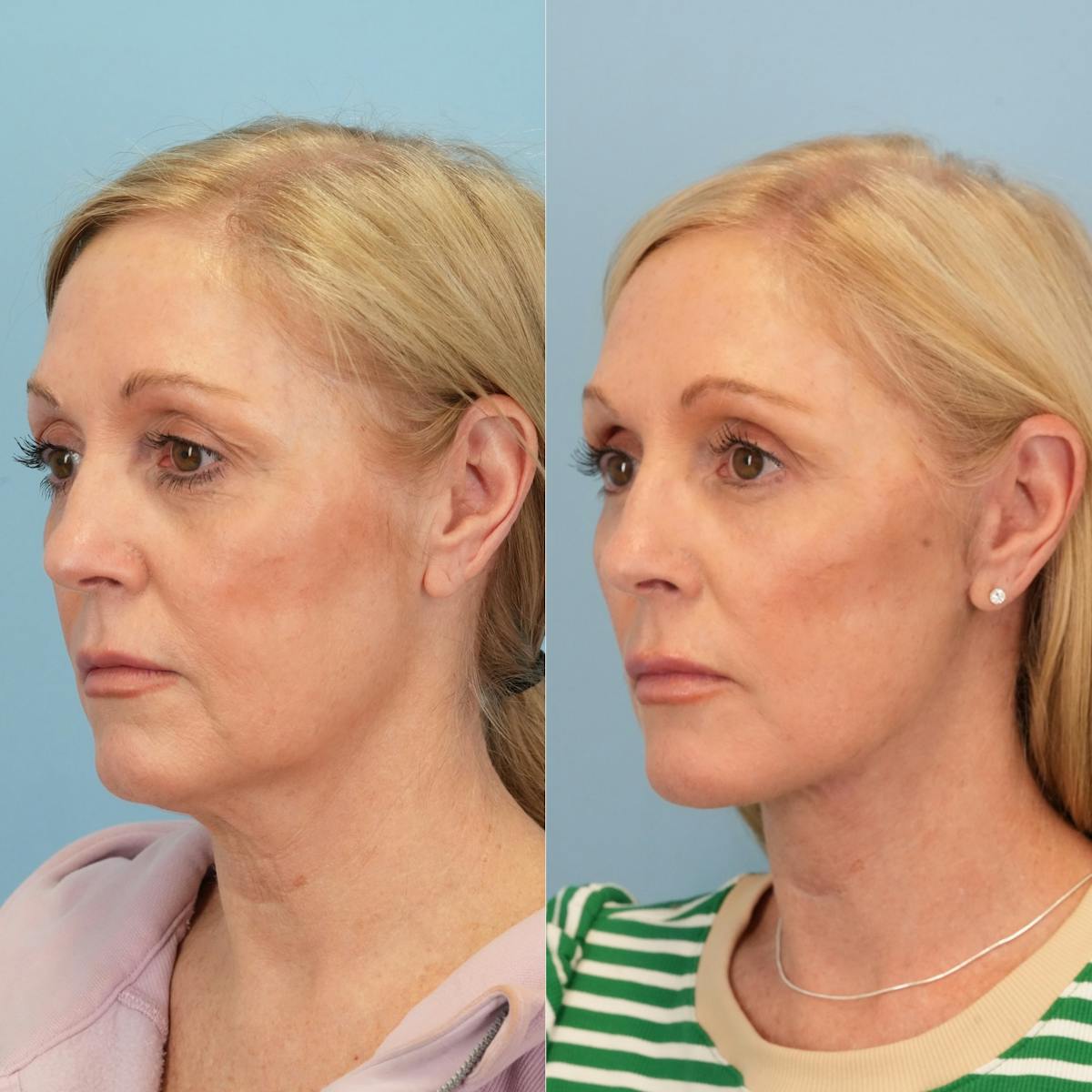 Facelift Before & After Gallery - Patient 179170 - Image 4