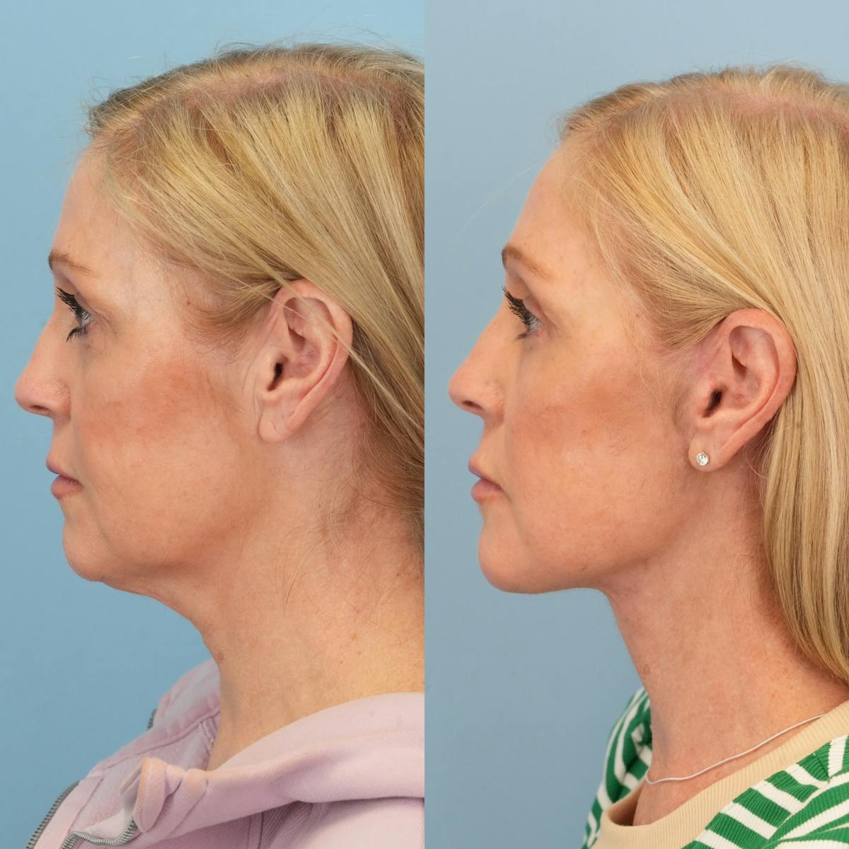 Facelift Before & After Gallery - Patient 179170 - Image 5