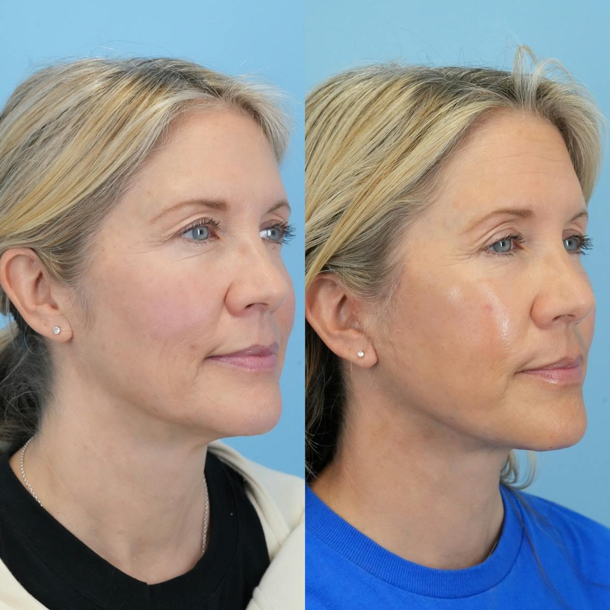 Facelift Before & After Gallery - Patient 230593 - Image 2