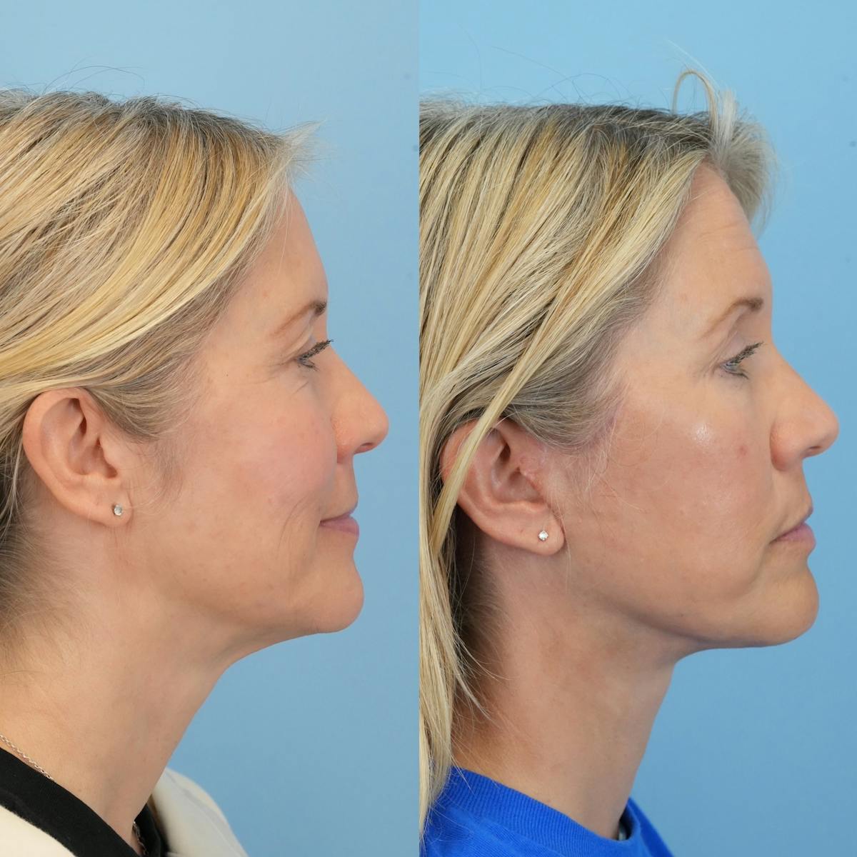 Facelift Before & After Gallery - Patient 230593 - Image 3