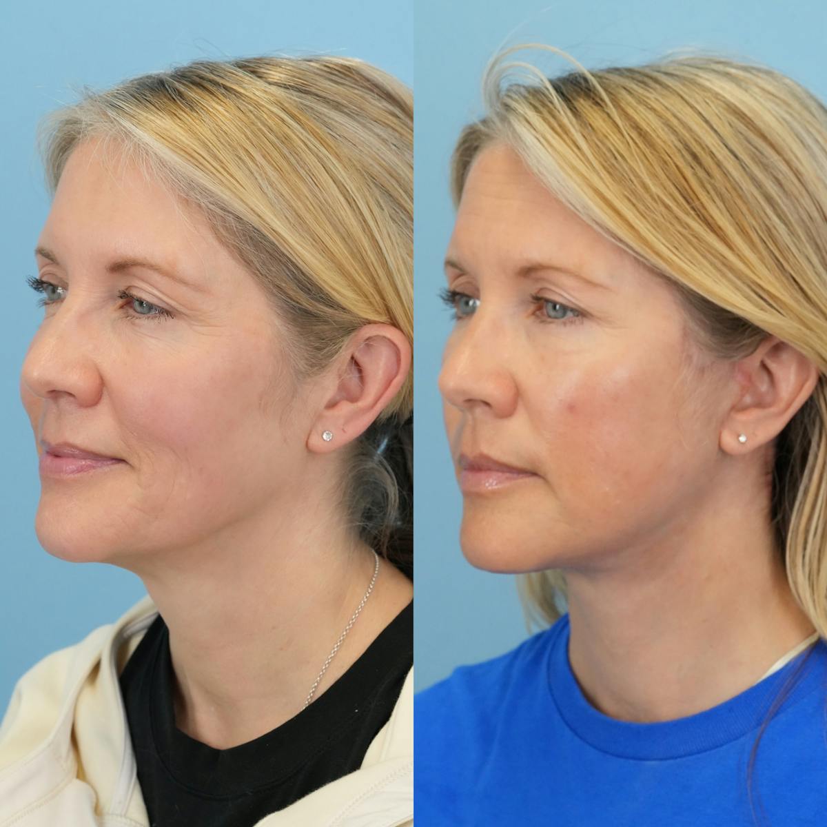 Facelift Before & After Gallery - Patient 230593 - Image 4