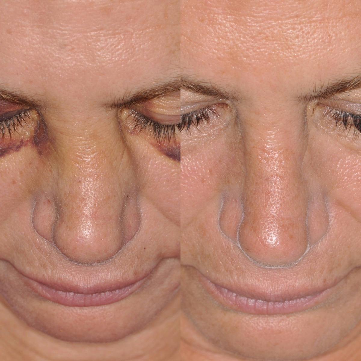 Facial Reconstruction Before & After Gallery - Patient 271951 - Image 2