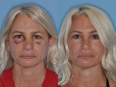 Facial Reconstruction Before & After Gallery - Patient 271951 - Image 1