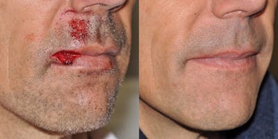 Facial Reconstruction Before & After Gallery - Patient 406491 - Image 1