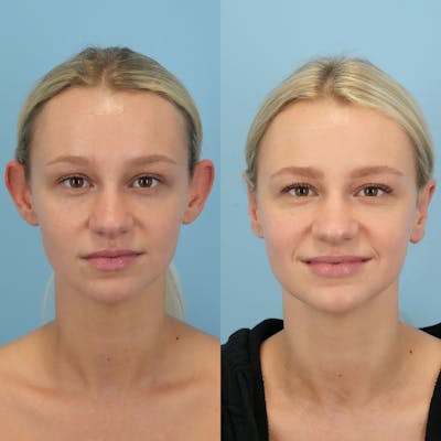 Otoplasty Before & After Gallery - Patient 118482 - Image 1