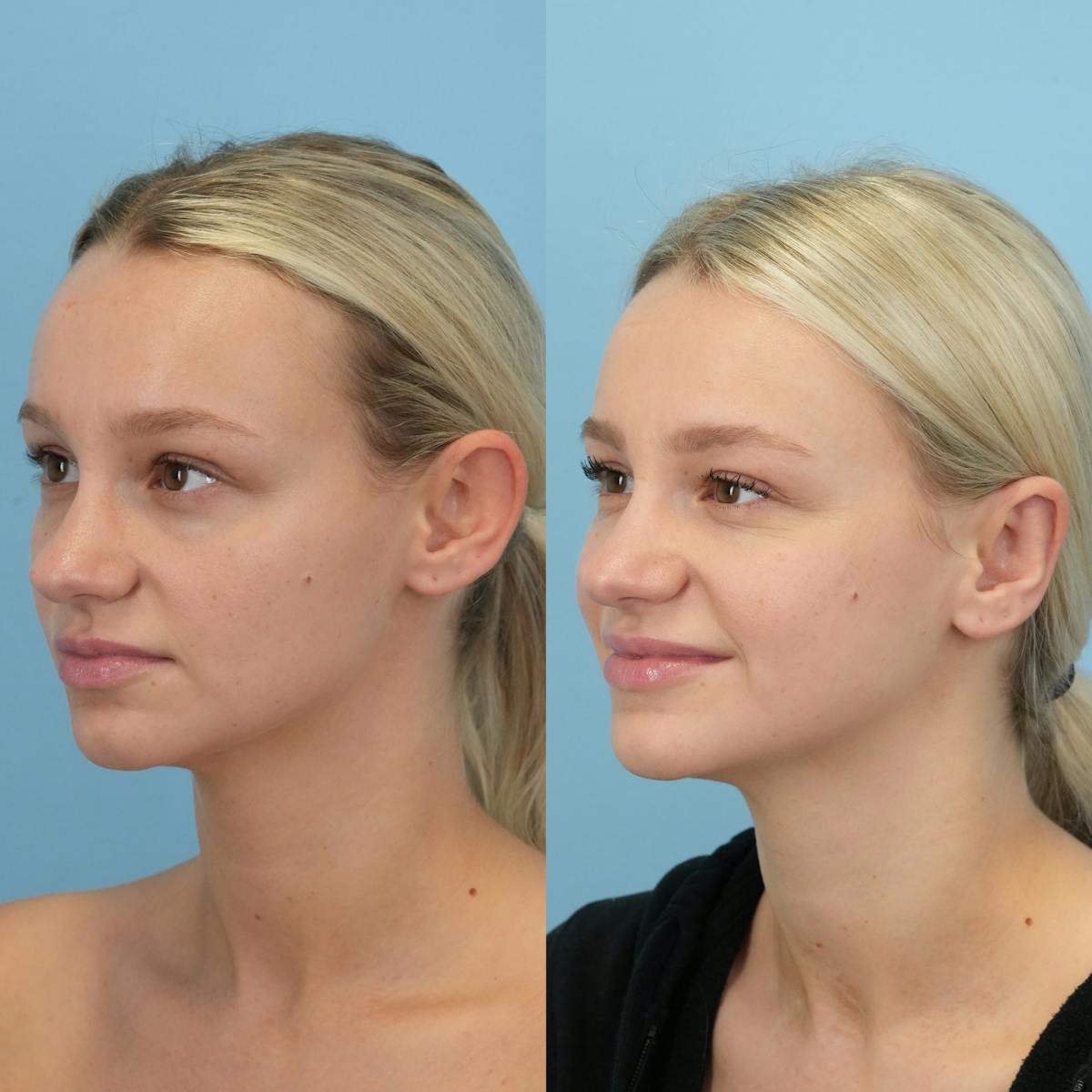 Otoplasty Before & After Gallery - Patient 118482 - Image 4