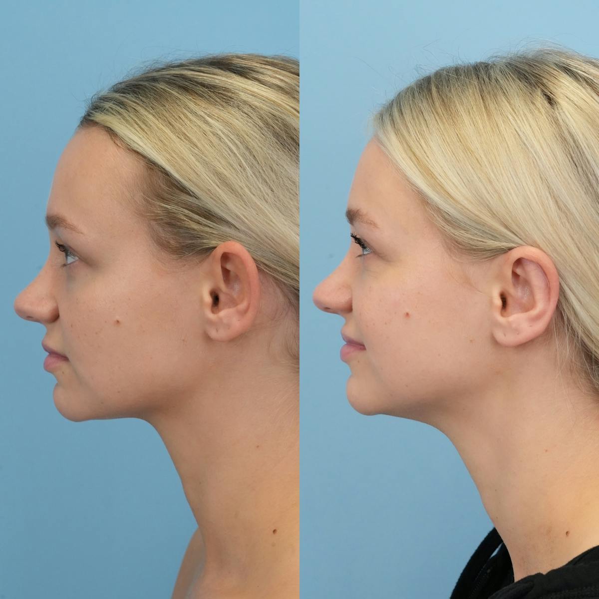 Otoplasty Before & After Gallery - Patient 118482 - Image 5