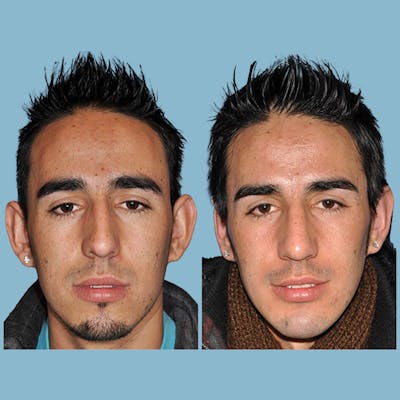 Otoplasty Before & After Gallery - Patient 395242 - Image 1