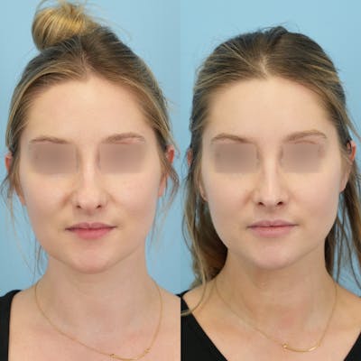 Rhinoplasty Before & After Gallery - Patient 132314 - Image 1