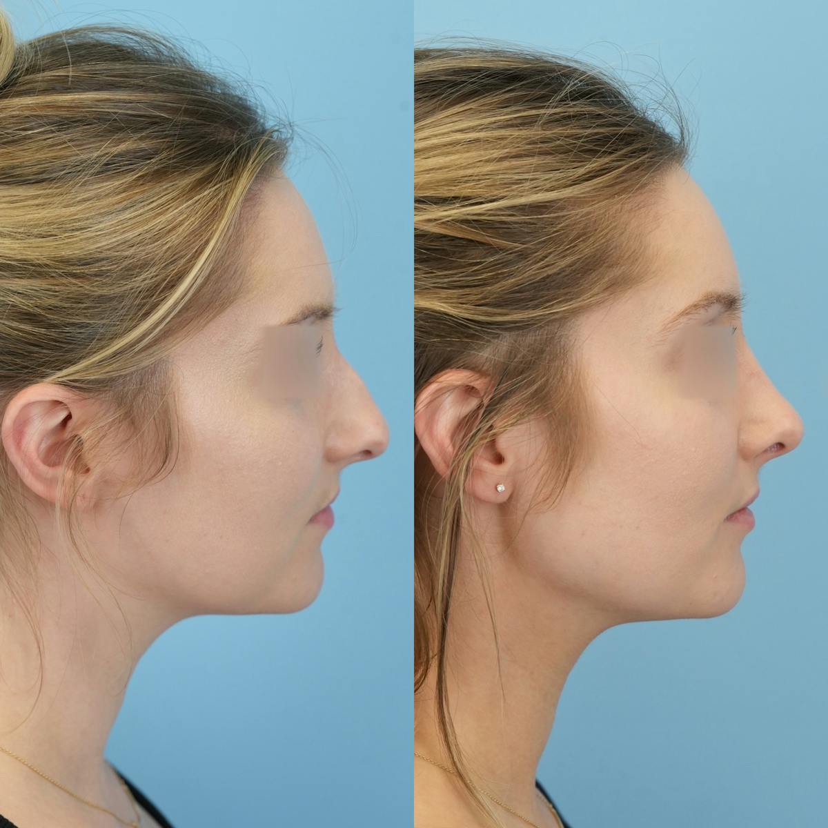 Rhinoplasty Before & After Gallery - Patient 132314 - Image 3