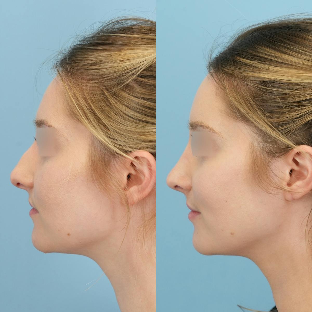 Rhinoplasty Before & After Gallery - Patient 132314 - Image 6