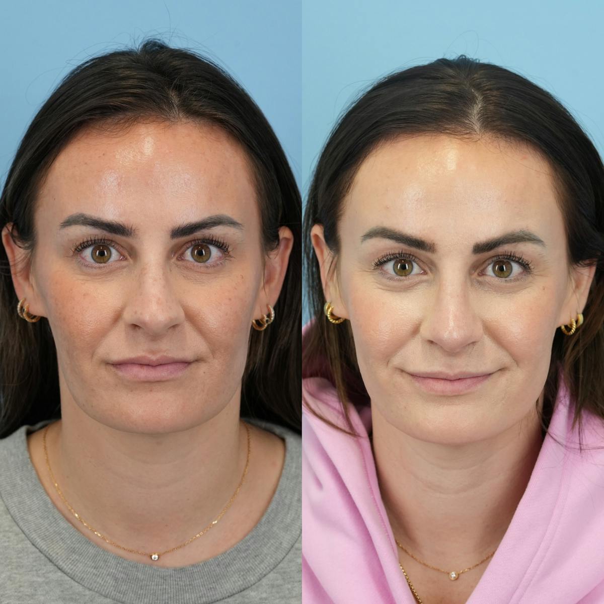 Rhinoplasty Before & After Gallery - Patient 811912 - Image 1
