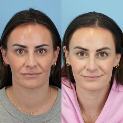 Rhinoplasty Before & After Gallery - Patient 811912 - Image 1
