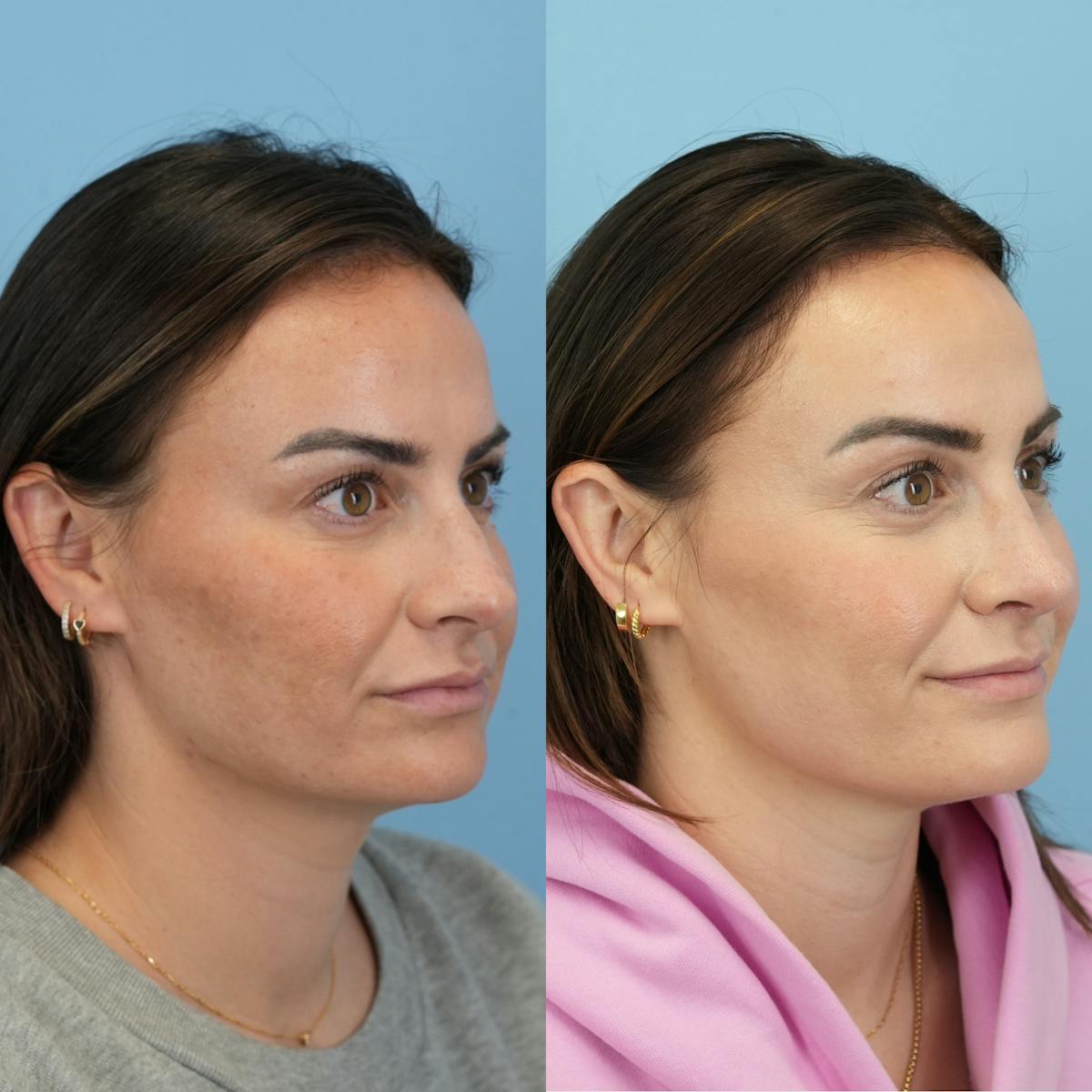 Rhinoplasty Before & After Gallery - Patient 811912 - Image 2