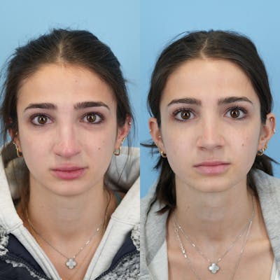 Rhinoplasty Before & After Gallery - Patient 303444 - Image 1