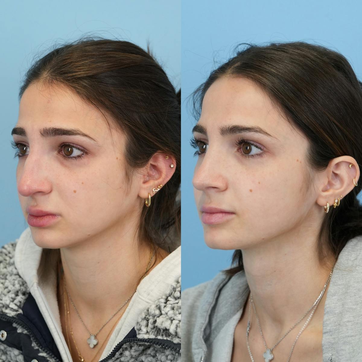 Rhinoplasty Before & After Gallery - Patient 303444 - Image 5