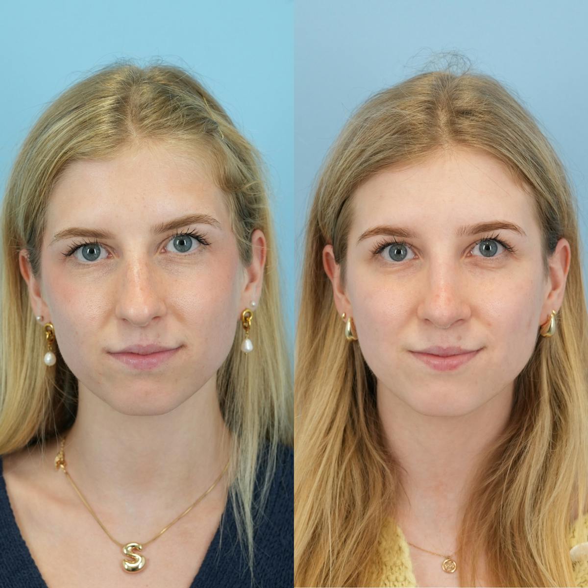 Rhinoplasty Before & After Gallery - Patient 230621 - Image 1