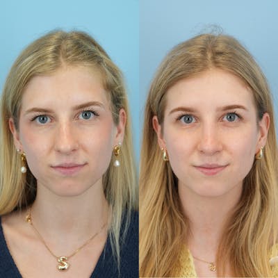 Rhinoplasty Before & After Gallery - Patient 230621 - Image 1