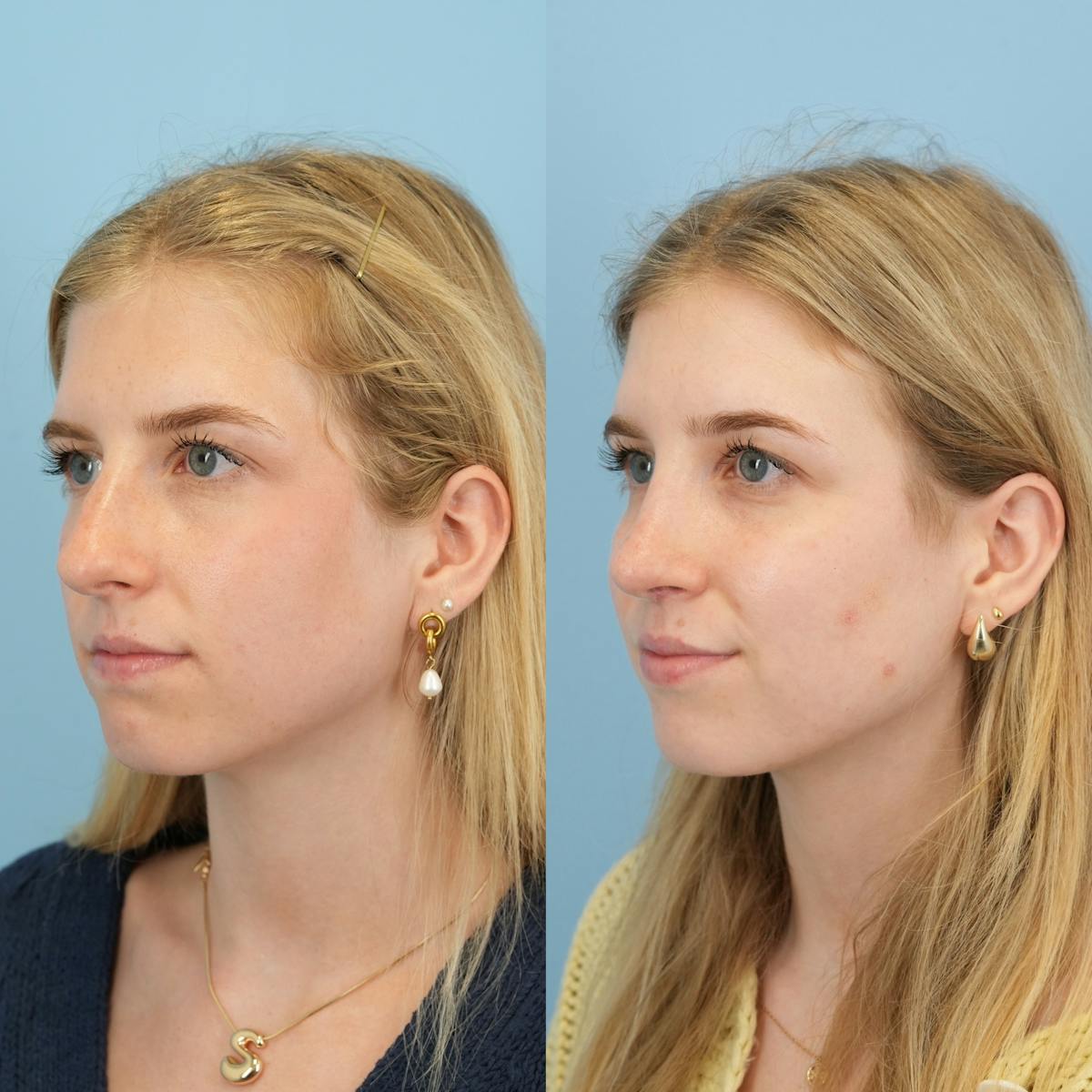 Rhinoplasty Before & After Gallery - Patient 230621 - Image 5