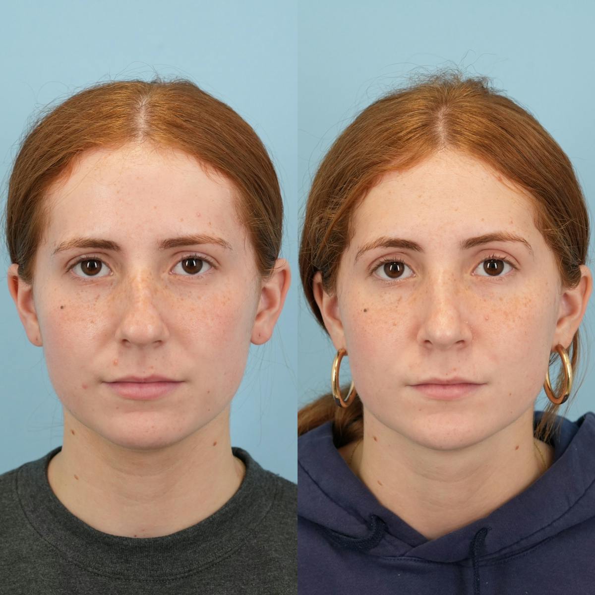 Blepharoplasty Before & After Gallery - Patient 425035 - Image 1