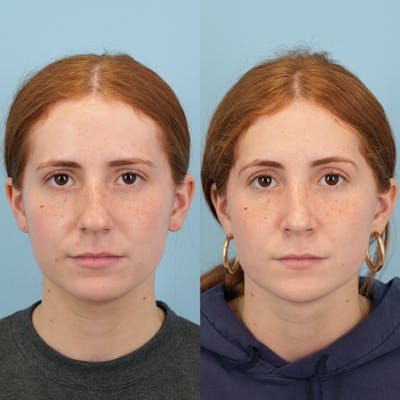 Rhinoplasty Before & After Gallery - Patient 280061 - Image 1