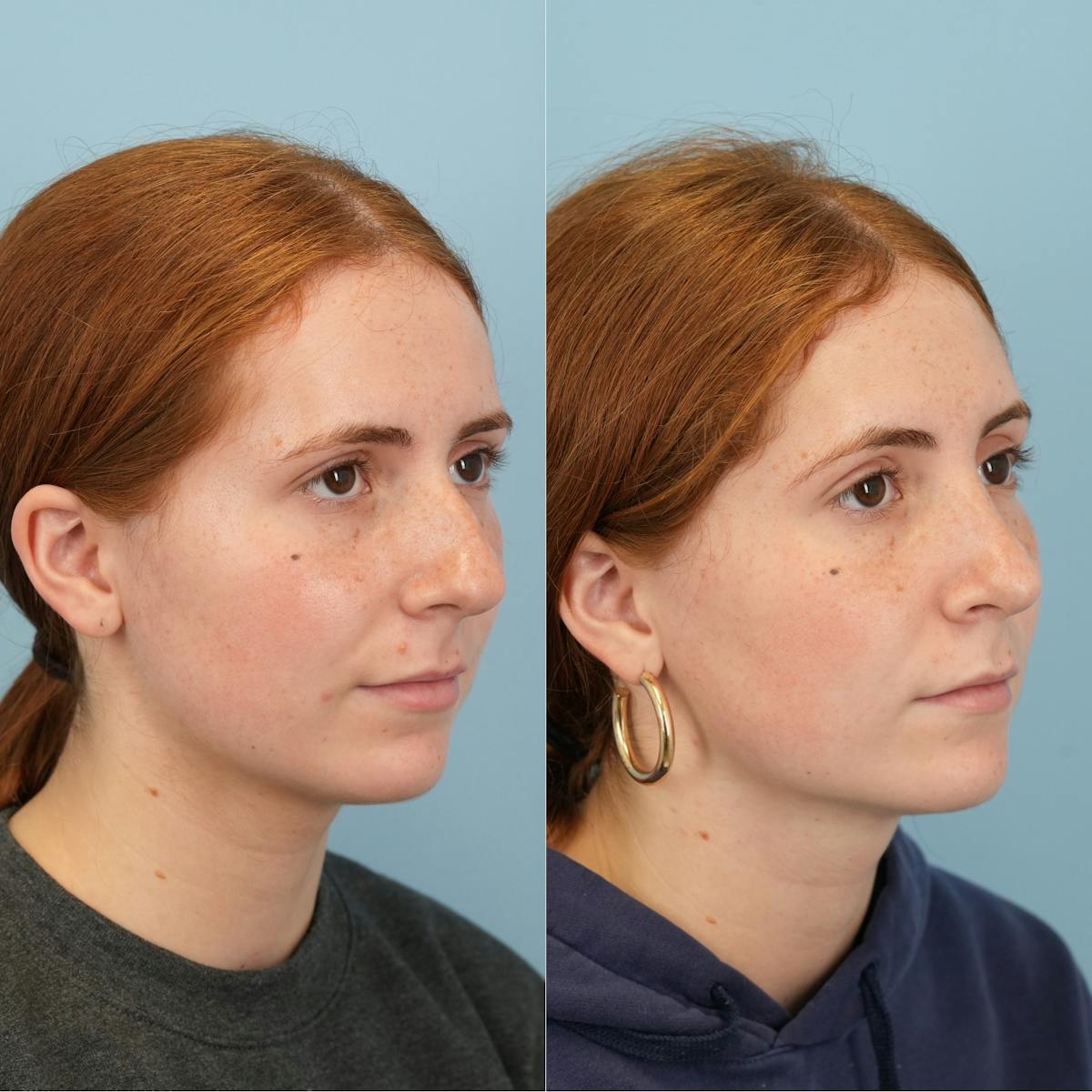 Blepharoplasty Before & After Gallery - Patient 425035 - Image 2