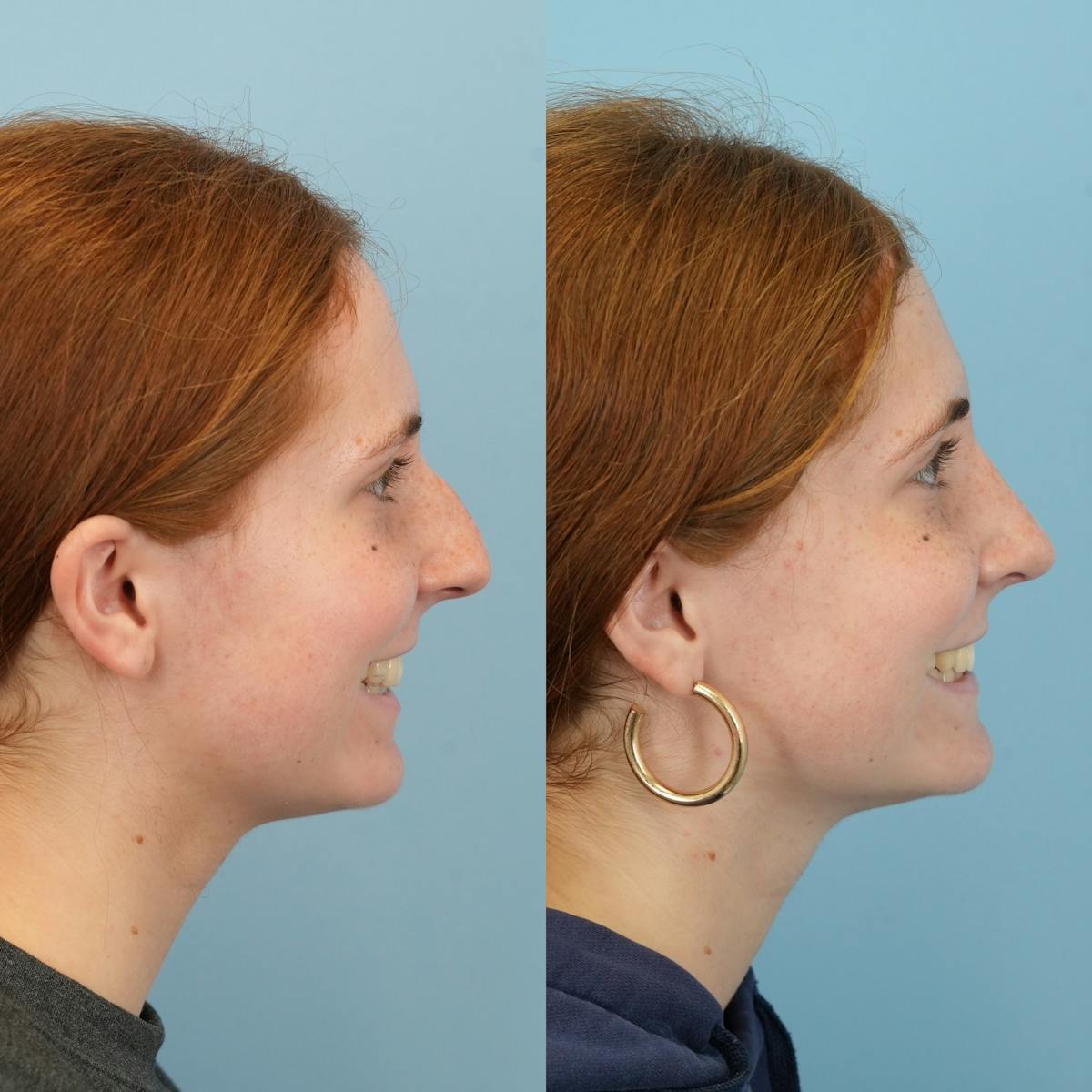 Blepharoplasty Before & After Gallery - Patient 425035 - Image 4