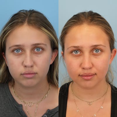Rhinoplasty Before & After Gallery - Patient 421297 - Image 1