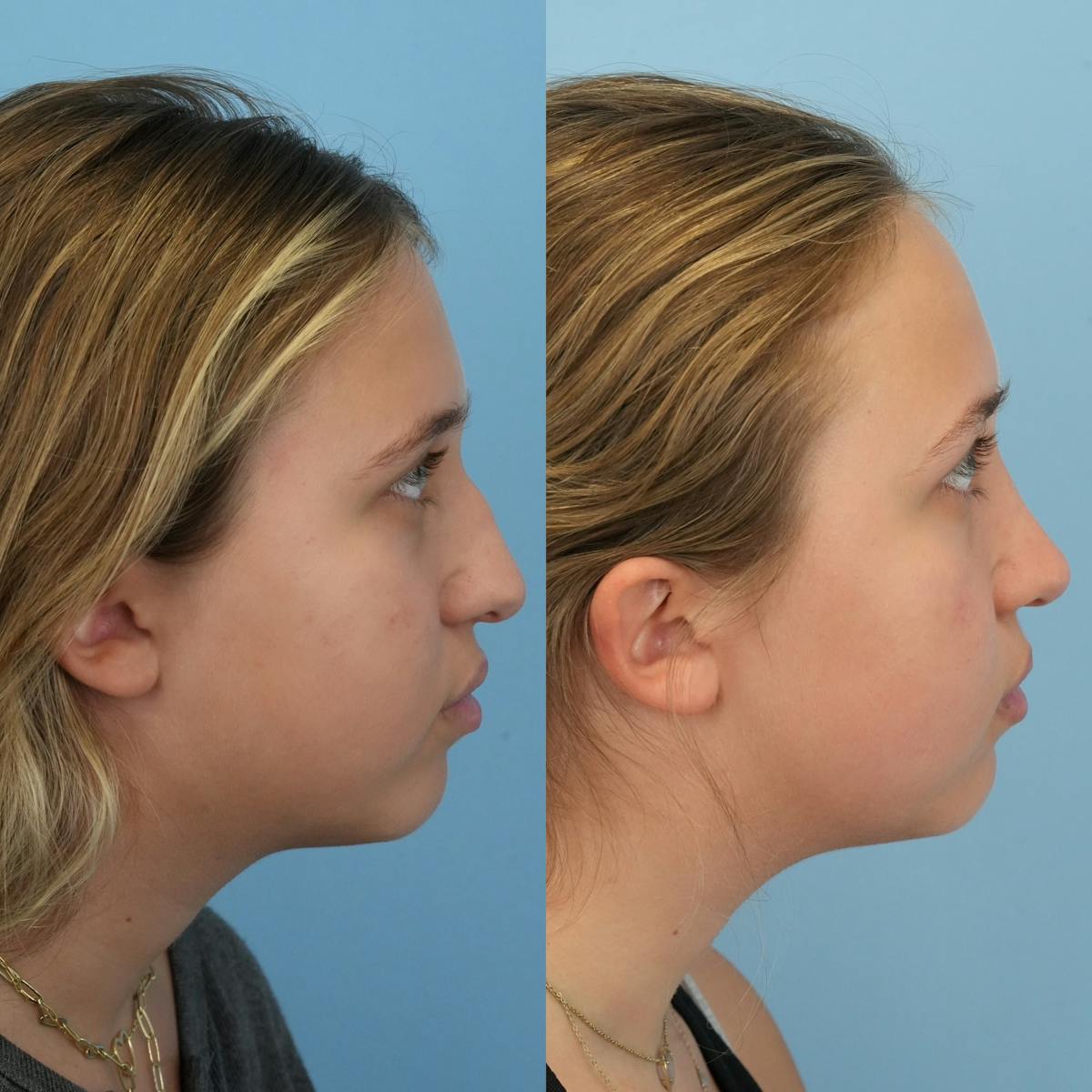 Rhinoplasty Before & After Gallery - Patient 421297 - Image 3