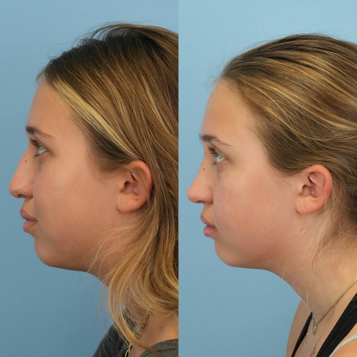 Rhinoplasty Before & After Gallery - Patient 421297 - Image 6