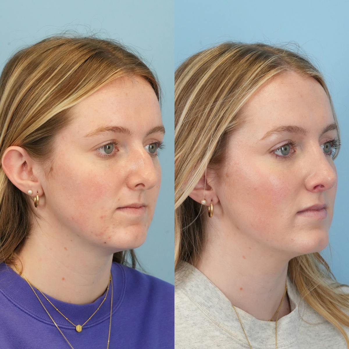 Rhinoplasty Before & After Gallery - Patient 942451 - Image 2