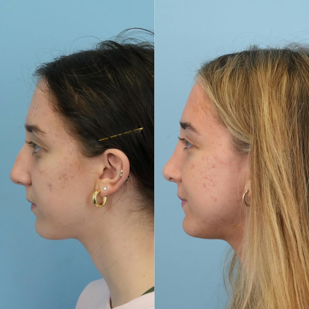 Rhinoplasty Before & After Gallery - Patient 119909 - Image 7