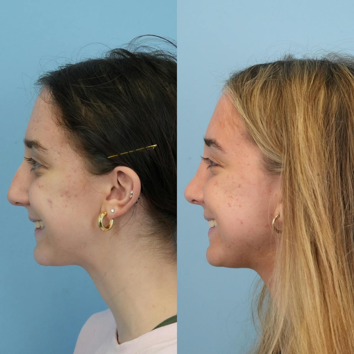 Rhinoplasty Before & After Gallery - Patient 119909 - Image 8
