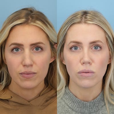 Rhinoplasty Before & After Gallery - Patient 127448 - Image 1